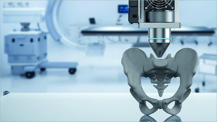 3D-printed implants designed for growing bones — limb salvage in pediatric bone cancer.