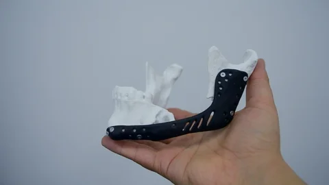 For complex bone-tumor reconstruction, 3D-printed custom implants are now standard at China's leading centers.