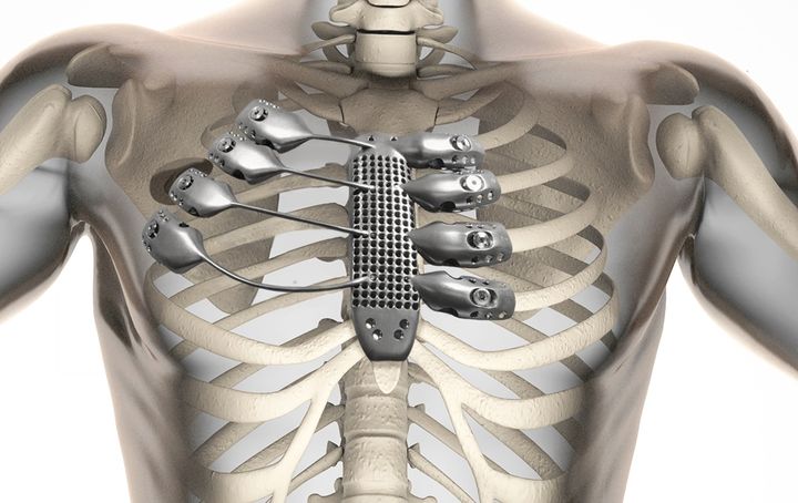 Custom 3D-printed titanium implants designed for each patient's exact bone defect.