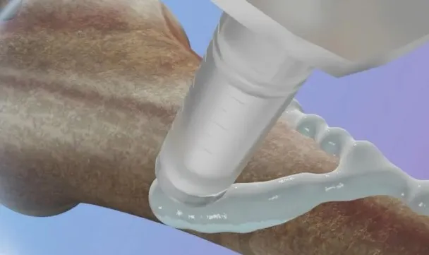 A frontier Chinese biomaterial pointing to less invasive fracture fixation.