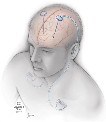 DBS can help selected Parkinson's and movement-disorder patients when medication is no longer enough.
