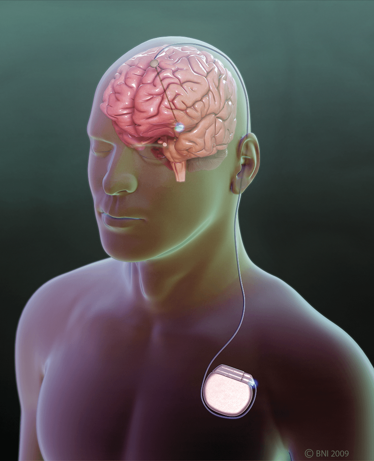 Chinese DBS platforms give neuromodulation teams more device choices.