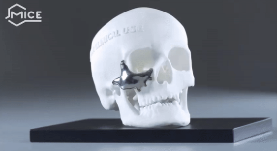 When standard implants are not enough, custom reconstruction may be possible.