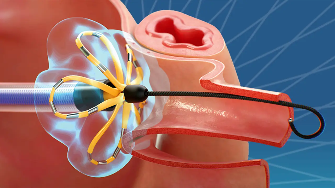 Pulsed field ablation (PFA) — non-thermal AF ablation that spares the esophagus and phrenic nerve.