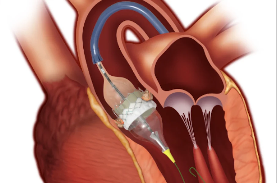 Chinese-engineered TAVR valves — CE-marked in Europe; J-Valve licensed to Edwards Lifesciences.