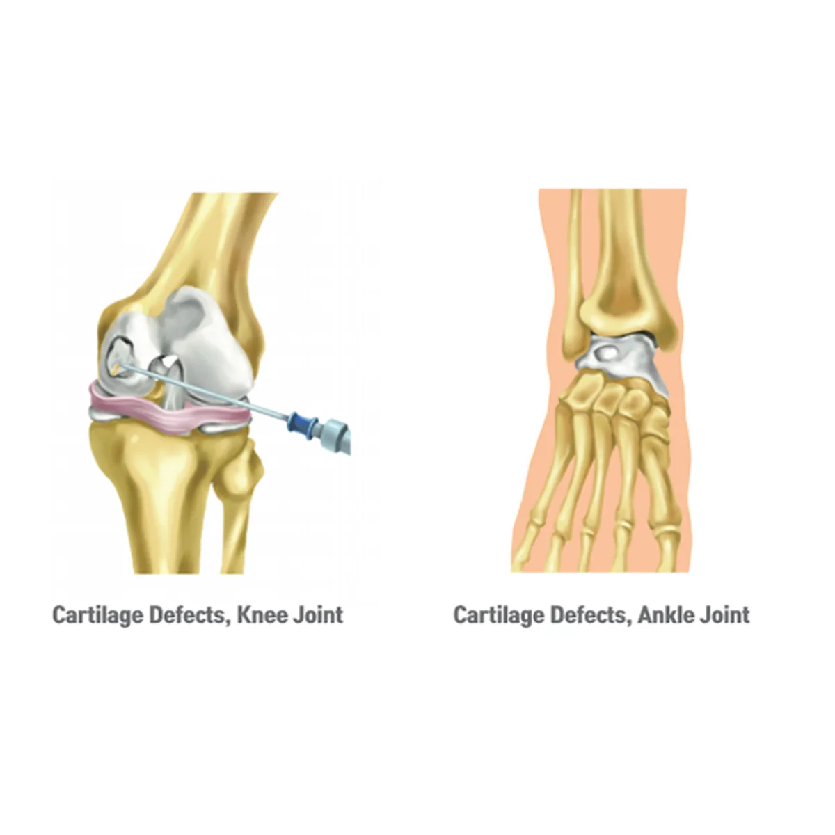 A China-approved biomaterial designed to support cartilage repair.