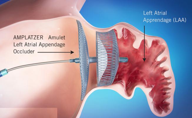 One-stop ablation + left atrial appendage occlusion — rhythm control and stroke prevention in a single admission.